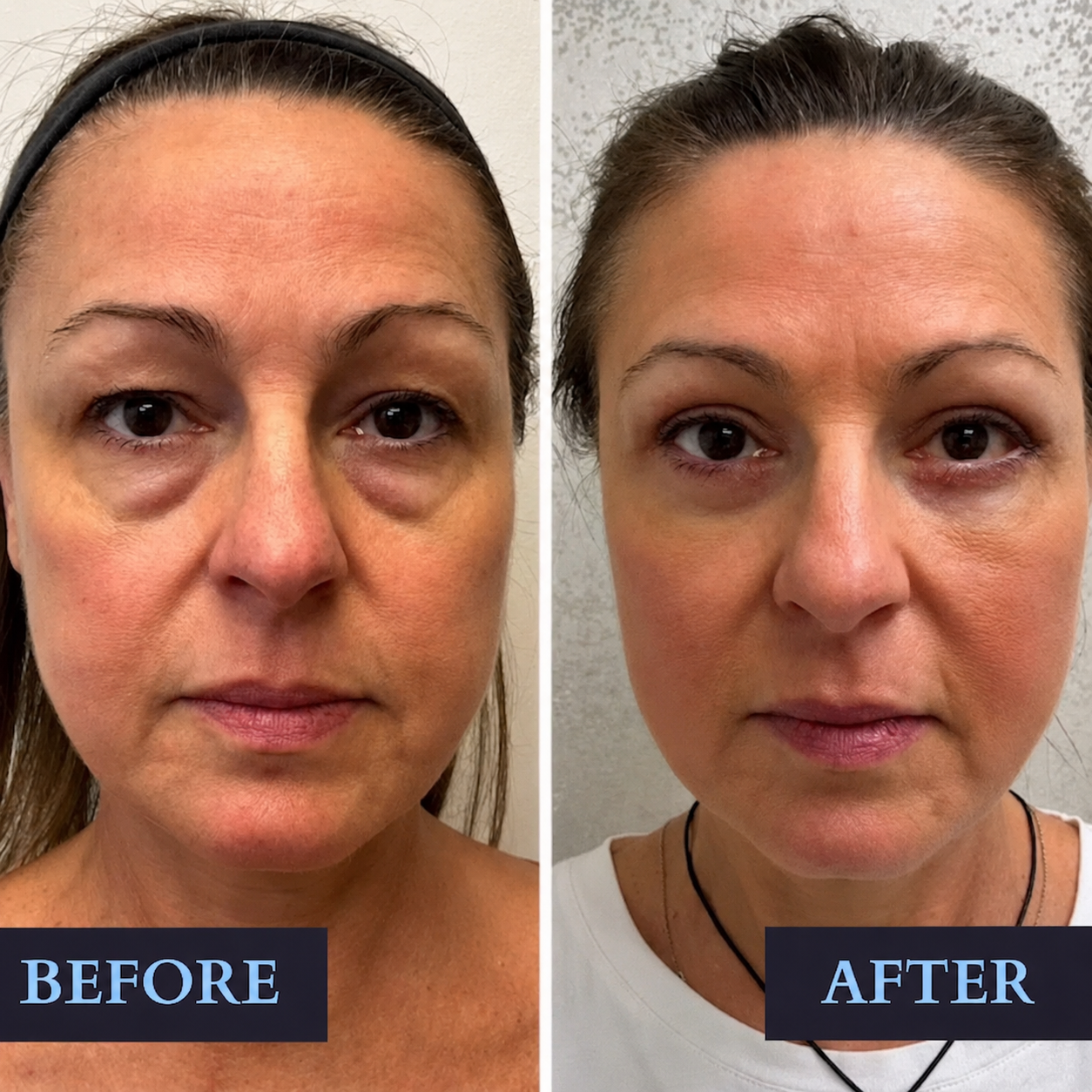 Instant Cream for Dark Circles and Wrinkles